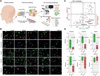 Ex Vivo Drug Screening Informed Targeted Therapy for Metastatic Parotid Squamous Cell Carcinoma